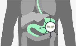 CLDN18.2 expressed in lymph node metastases of gastric adenocarcinoma and other metastatic sites 