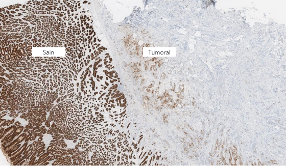 Normal and tumour cell CLDN18.2 staining at 2x magnification